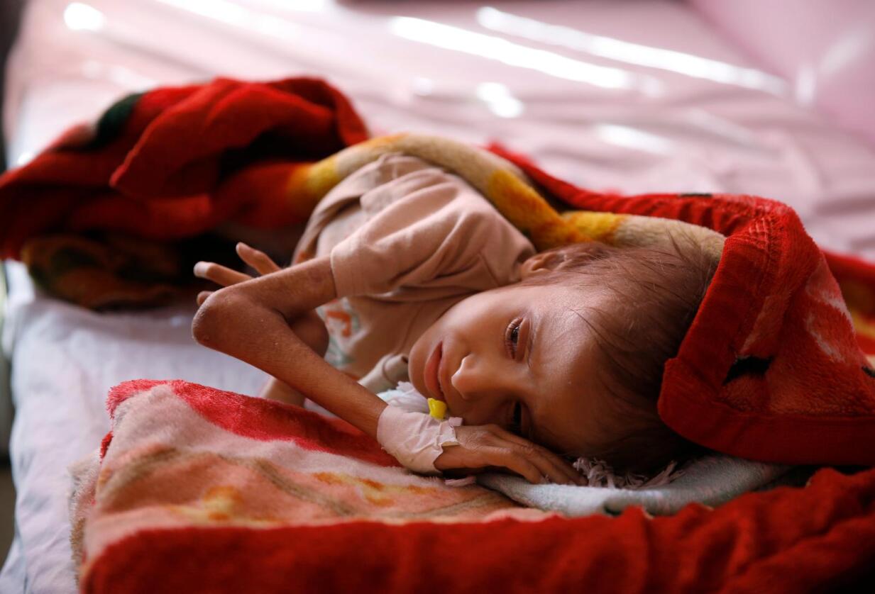 Et underernært barn venter på å få behandling ved et sykehus i Jemens hovedstad Sana i 2016. Arkivfoto: Hani Mohammed / AP / NTB scanpix